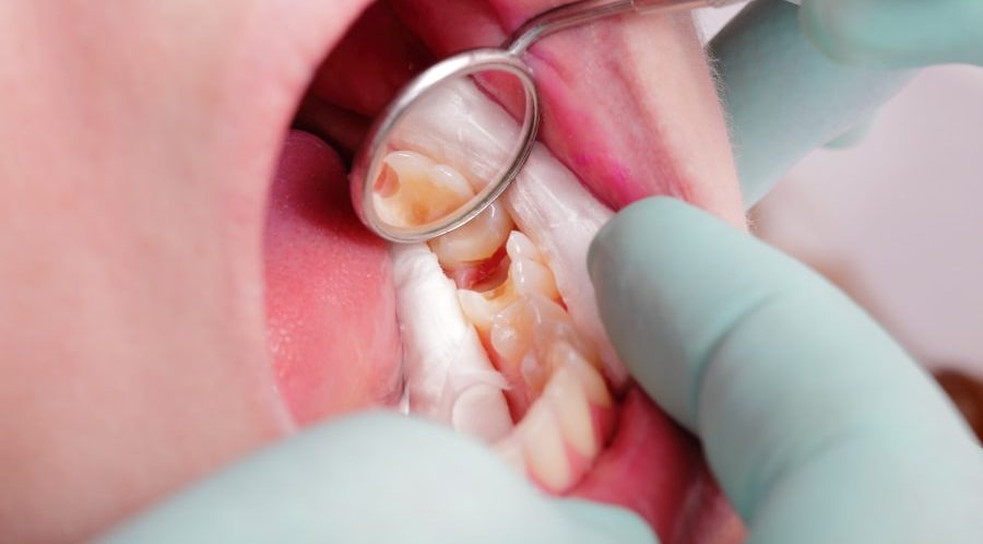 Sâu Răng Ở Trẻ Mầm Non: Hiểu Đúng Để Chăm Sóc Hiệu Quả